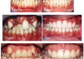 Tổng hợp những câu hỏi đáp về răng miệng