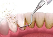 Dịch vụ điều trị nha chu
